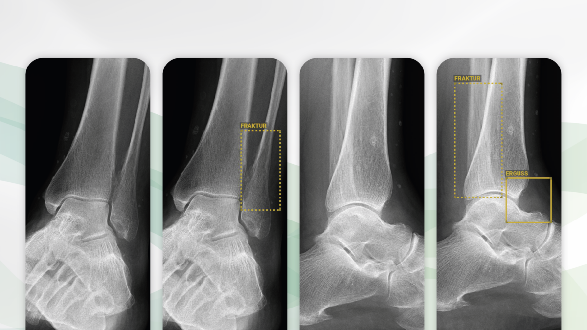 BoneviewTrauma blog